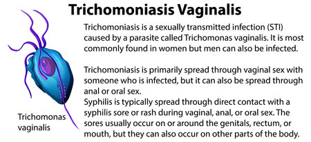 Trichomoniasis Vaginalis with explanation illustrationのイラスト素材