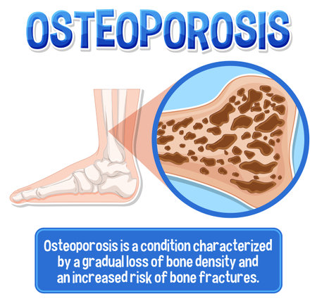 Informative poster of Osteoporosis human bone illustrationのイラスト素材