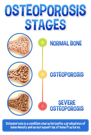 Informative poster of Osteoporosis human bone illustrationのイラスト素材