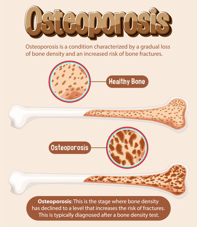 Informative poster of Osteoporosis human bone illustrationのイラスト素材