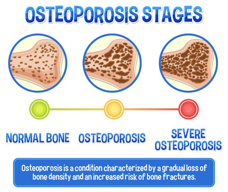 Informative poster of Osteoporosis human bone illustrationのイラスト素材