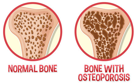 Comparison of normal bone and bone with Osteoporosis illustrationのイラスト素材