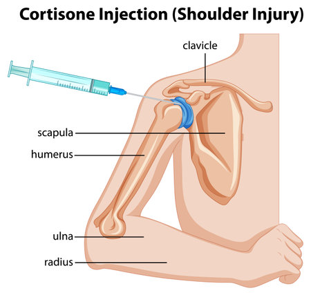 Cortisone Injection (Shoulder Injury) diagram illustrationのイラスト素材
