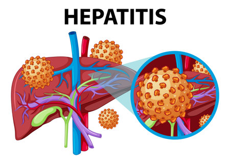 Illustration depicting the science and medical education of human liver with hepatitisのイラスト素材