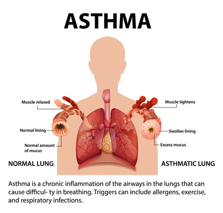 Illustration comparing normal and asthma lungs for medical educationのイラスト素材