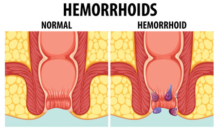 Educational graphic illustrating the differences between normal and internal hemorrhoidsのイラスト素材