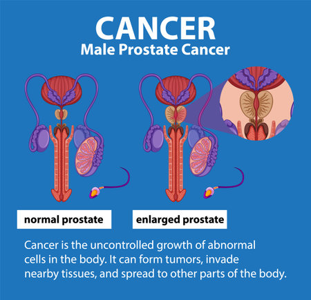 Illustrated infographic highlighting differences between healthy and cancerous prostateのイラスト素材