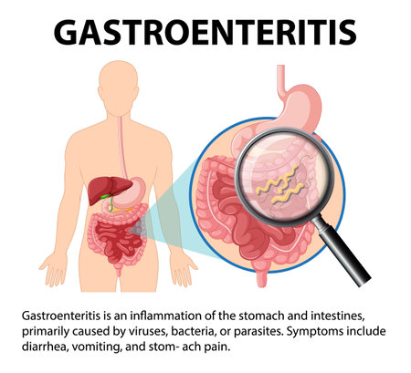 An infographic illustrating gastroenteritis, its causes, and symptomsのイラスト素材