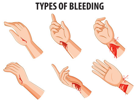 Vector cartoon illustration comparing various types of bleeding on human armsのイラスト素材