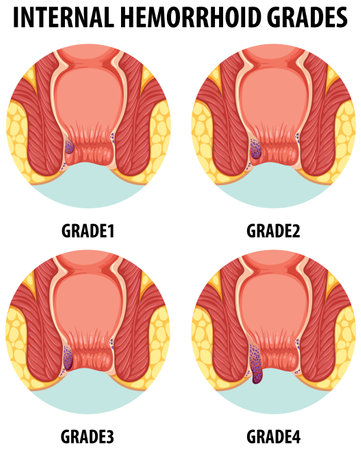 Detailed cartoon illustration showing various grades of internal hemorrhoidsのイラスト素材