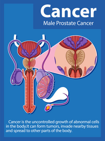 Infographic illustrating the differences between normal and cancerous prostate cellsのイラスト素材
