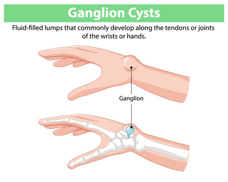 Illustration of ganglion cysts on hands and wristsのイラスト素材