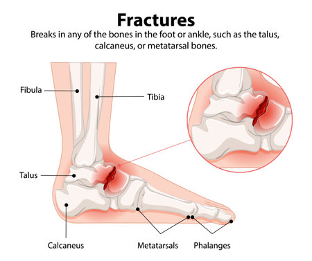 Illustration of fractures in foot and ankle bonesのイラスト素材