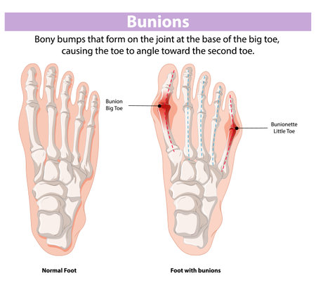 Illustration of normal foot and foot with bunionsのイラスト素材