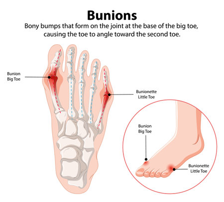Diagram showing bunions on foot bonesのイラスト素材