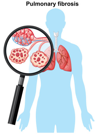 Vector illustration of pulmonary fibrosis with magnified alveoli, anatomical style, flat colorsのイラスト素材