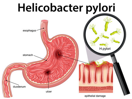 Vector diagram showing H. pylori bacteria, stomach ulcer, epithelial damage, labeled digestive anatomyのイラスト素材