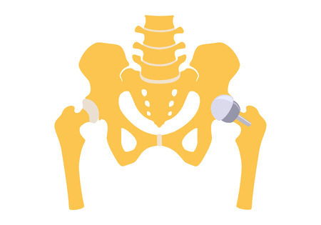 Hip replacement partly half. Vector illustration. Isolated on white backgroundのイラスト素材