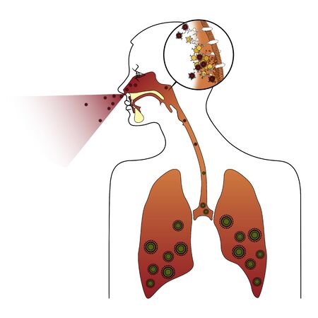Colds and inflammation. Flu. Silhouette of human lungs with coronavirus. Pneumonia. Vector illustrationのイラスト素材