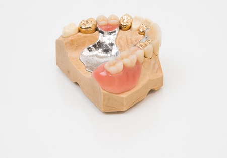 Sophisticated dental prosthesis with gold teeth, bridges and artificial teeth on a mold