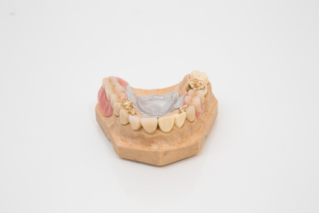 Sophisticated dental prosthesis with gold teeth, bridges and artificial teeth on a moldの写真素材