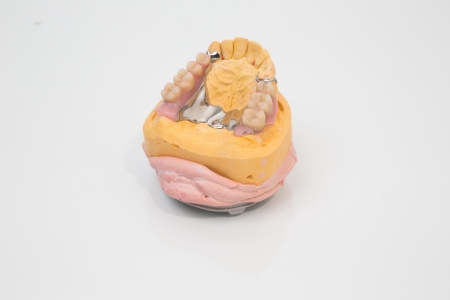 Dental bridge and artificial teeth on a mold
