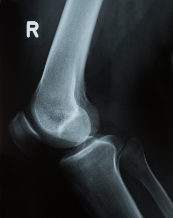 X-ray photograph or Röntgen image of a human knee with tibia, femur, fubula and patellaの写真素材