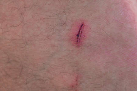 scratch on man's leg. wound on the skin.