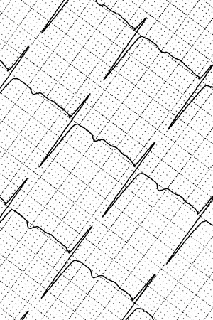 Electrocardiogram test that shows electrical activity of the heart