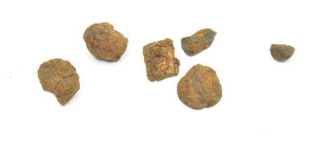 Liver stones -  small stones often developed when there is an excess of cholesterol in the body