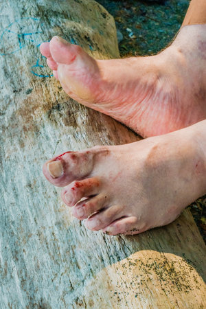 Mans bleeding bare feet after being cut by sharp rocks at an ocean beachの写真素材