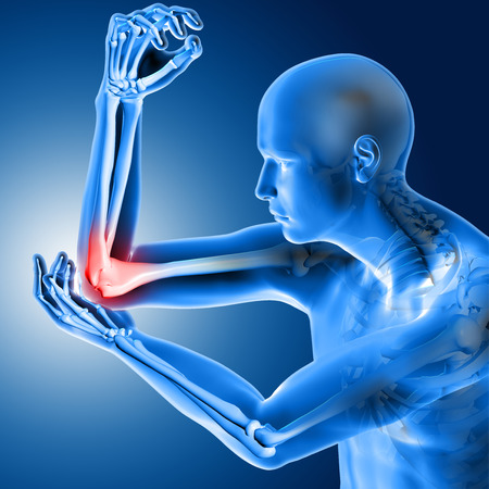 3d illustration of a medical figure with painful elbowの写真素材