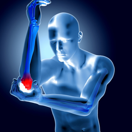 3d illustration of a medical figure with painful elbowの写真素材
