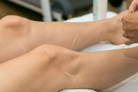 Acupuncture on the knee, treatment of osteoarthritis in the kneeの写真素材