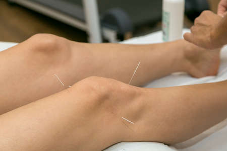 Acupuncture on the knee, treatment of osteoarthritis in the kneeの写真素材