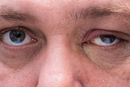 Close up of eye infection with swollen eyelid