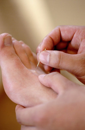 Acupuncture conceptの写真素材