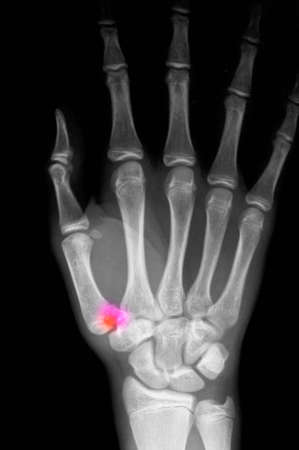 X-ray of fracture through base of thumb metacarpalの写真素材