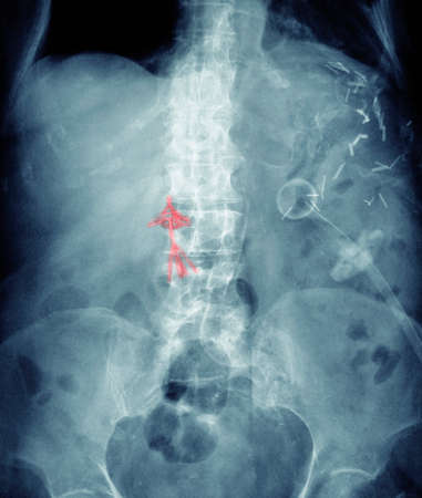X-ray of abdomen with Greenfield umbrella