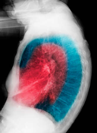 CXR of elderly woman smoker with COPDの写真素材