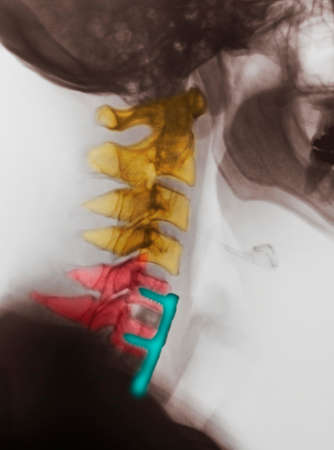 Cervical xray showing spinal fusion, C5, C6, C7の写真素材