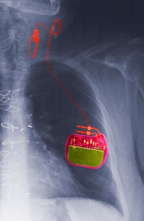 CXR with vagus nerve stimulator for epilepsy