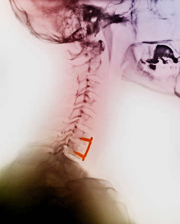 Cervical spine xray, spinal fusion, screws, plateの写真素材