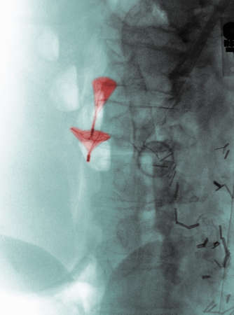 X-ray showing Greenfield umbrellaの写真素材
