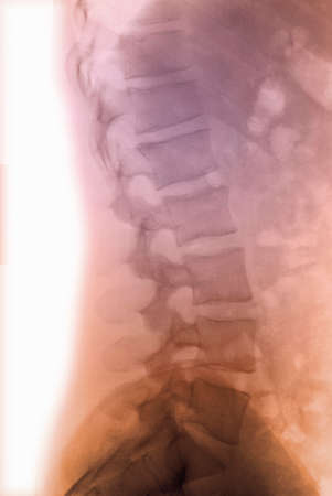normal x-ray of the lumbar spineの写真素材