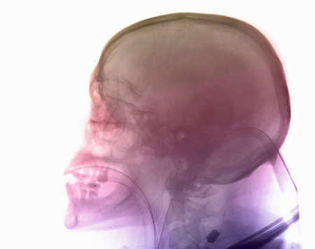 skull x-ray of man in a motorcycle accidentの写真素材