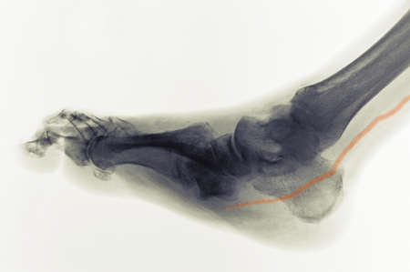 x-ray of foot of diabetic showing calcified artery