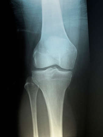 normal knee x-ray of a 58 year old manの写真素材
