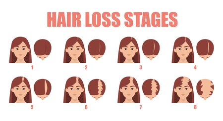 Hair loss stages vector isolated. Female alopecia. Set of balding process. Hairless woman heads front and top view.のイラスト素材