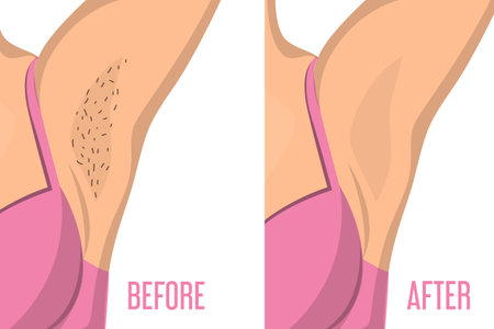 Armpit depilation before and after vector isolated. Female body, hair removal. Skin care, epilation procedure.のイラスト素材